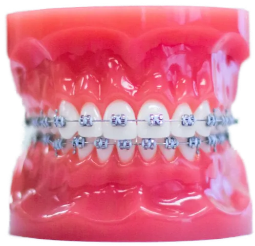 Metal braces