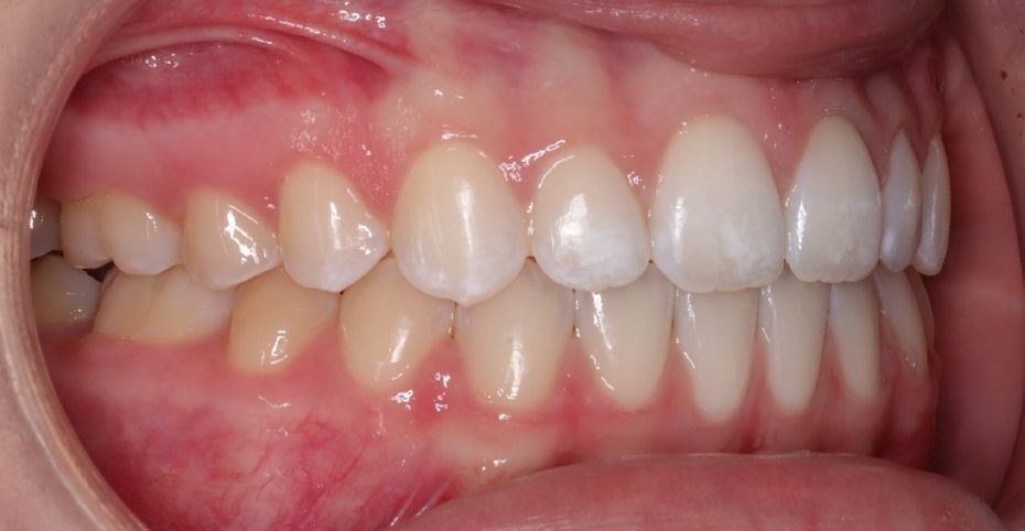 Case 9 after orthodontic treatment