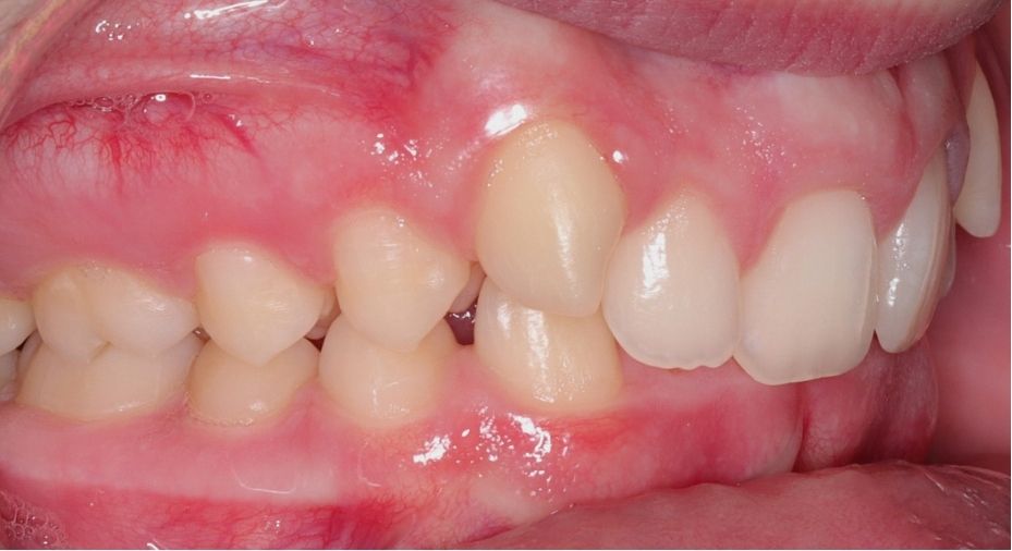 Case 12 before orthodontic treatment