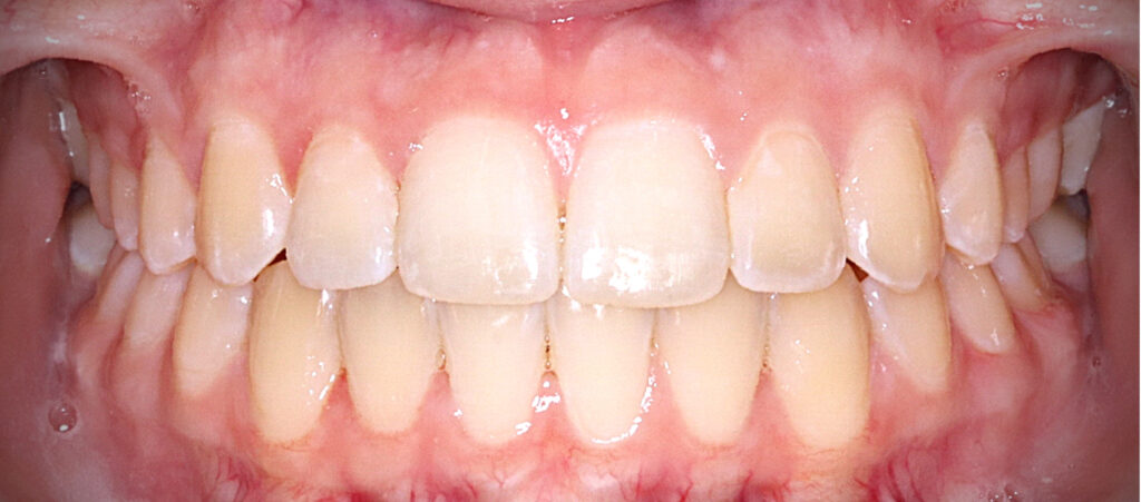 Case 1 after orthodontic treatment