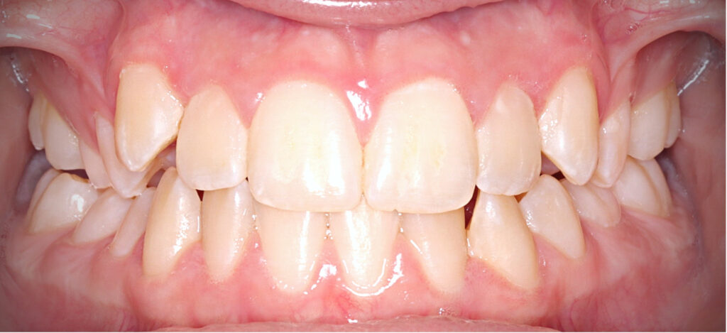 Case 1 before orthodontic treatment