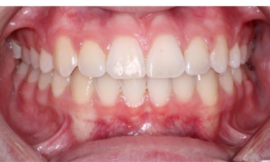 Case 2 after orthodontic treatment