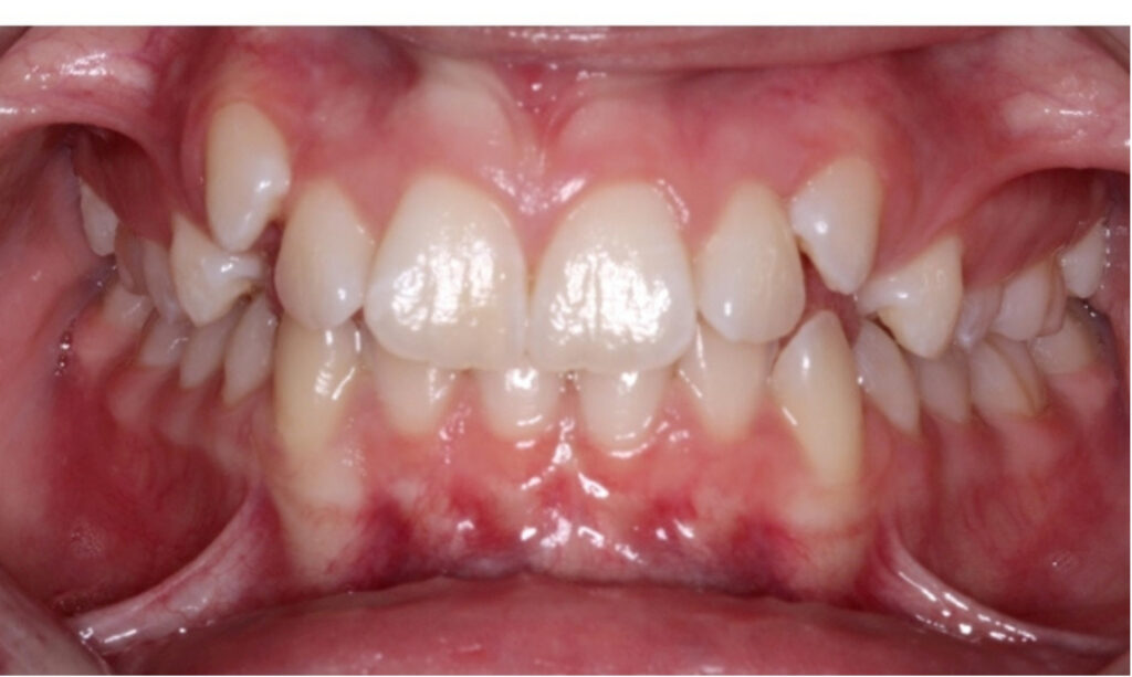 Case 2 before orthodontic treatment