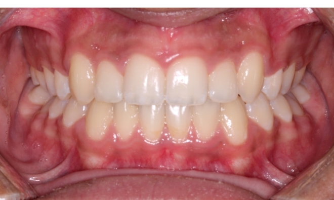Case 3 after orthodontic treatment