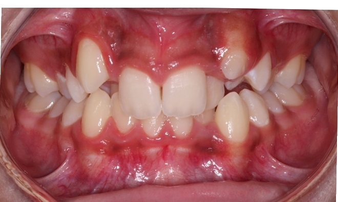 Case 3 before orthodontic treatment