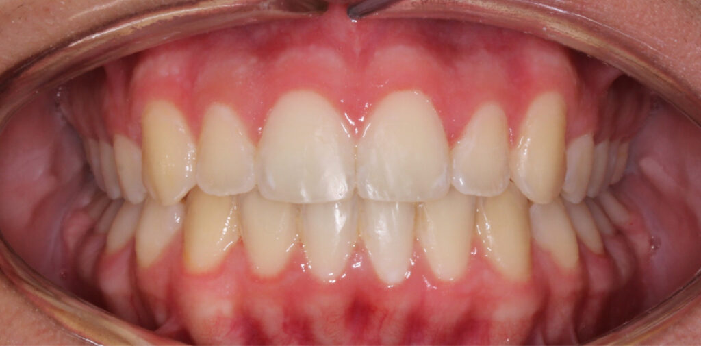 Case 4 after orthodontic treatment