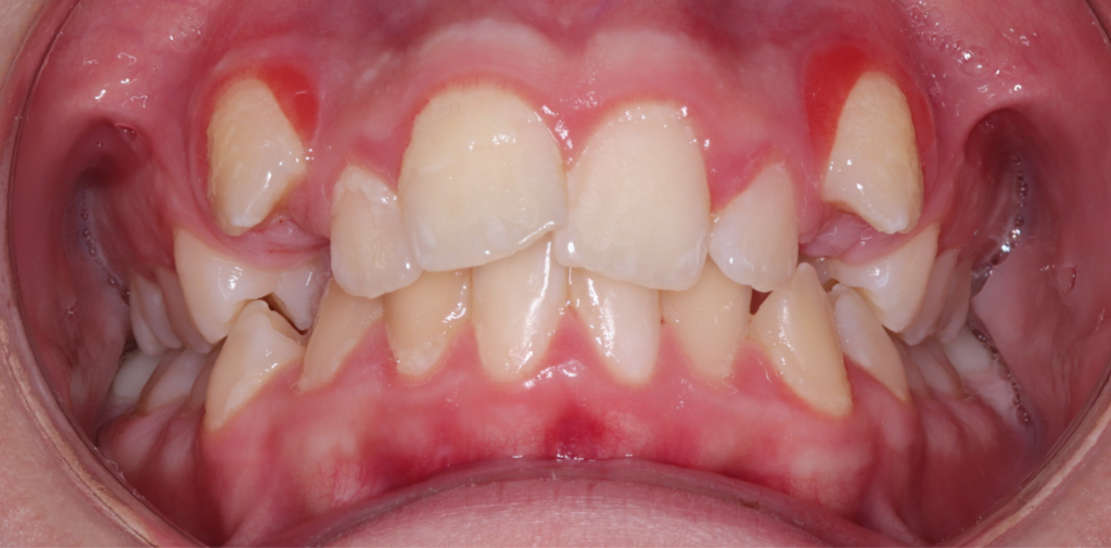 Case 4 before orthodontic treatment