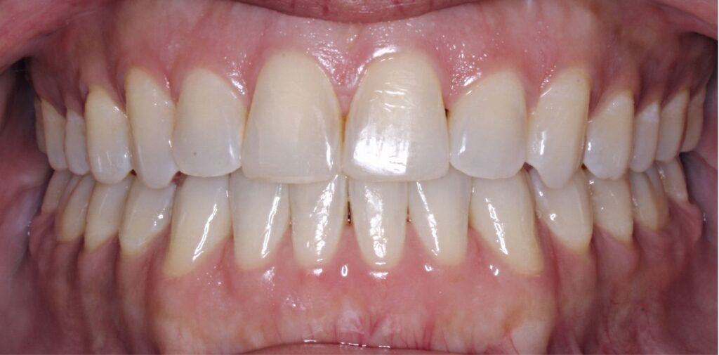 Case 5 after orthodontic treatment