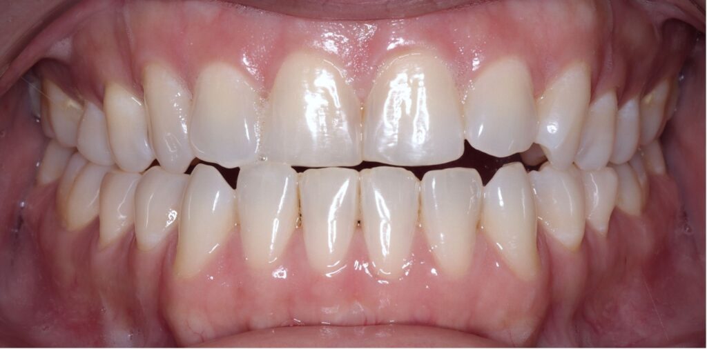 Case 5 before orthodontic treatment