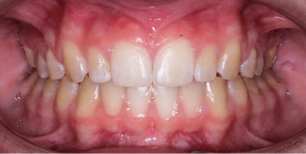 Case 6 after orthodontic treatment