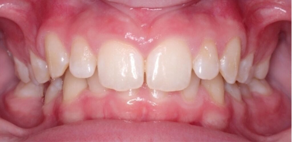 Case 6 before orthodontic treatment