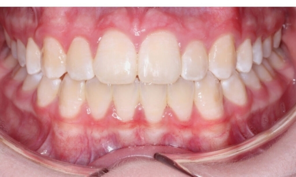 Case 7 after orthodontic treatment