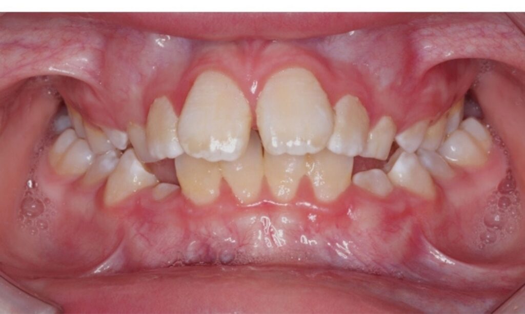 Case 7 before orthodontic treatment
