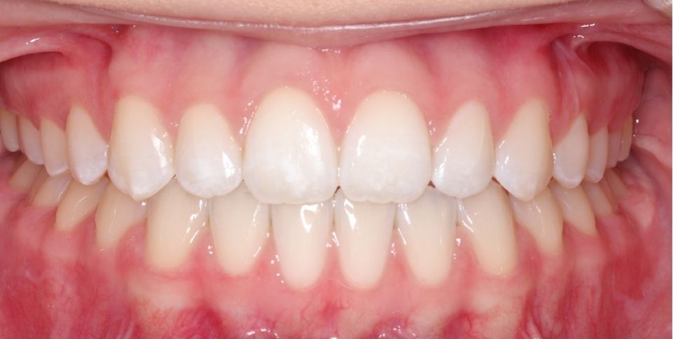 Case 8 after orthodontic treatment