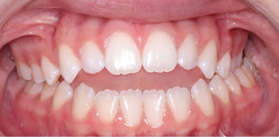 Case 8 before orthodontic treatment