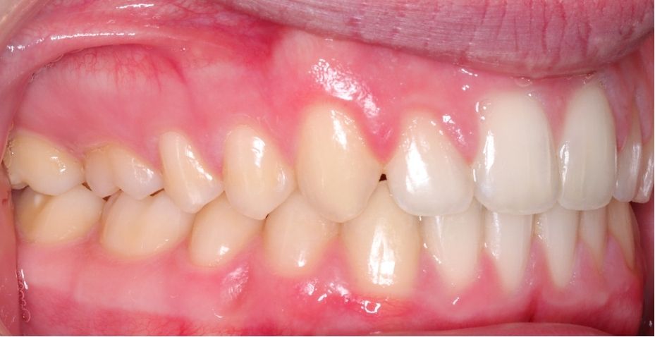 Case 12 after orthodontic treatment