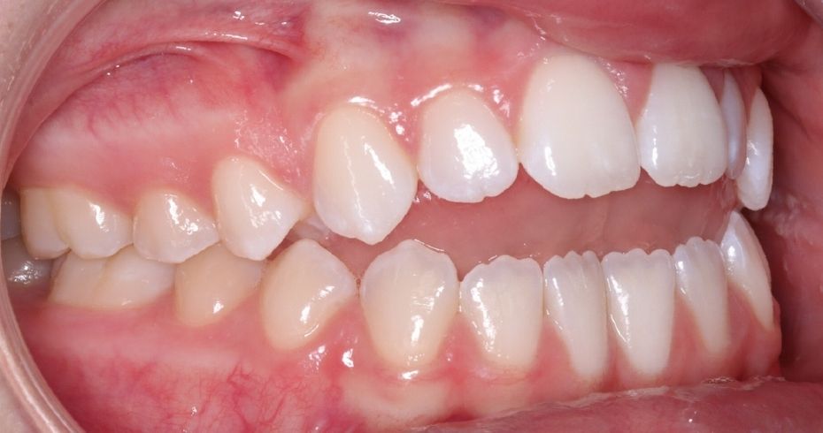 Case 9 before orthodontic treatment