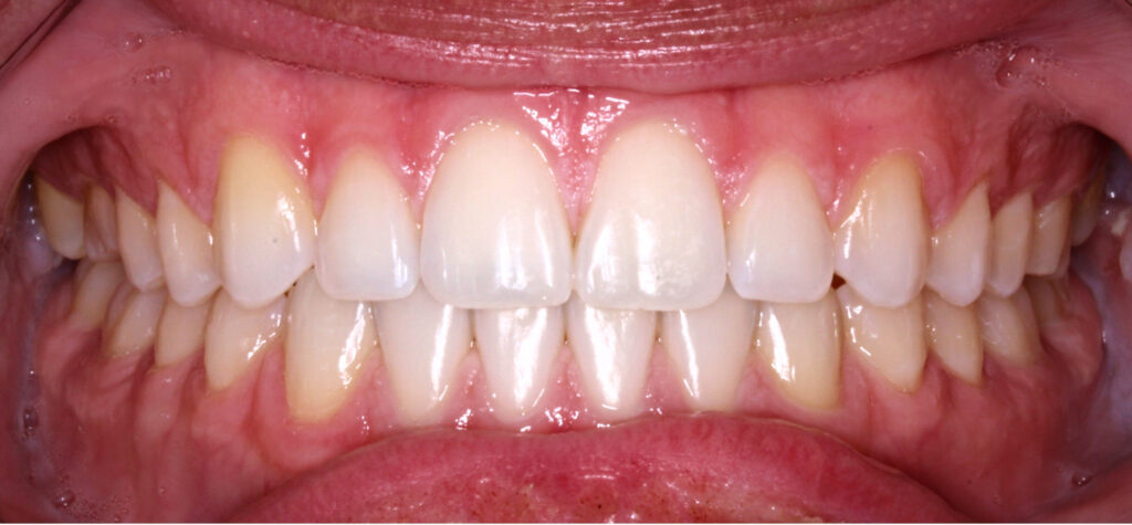 Case 10 after orthodontic treatment