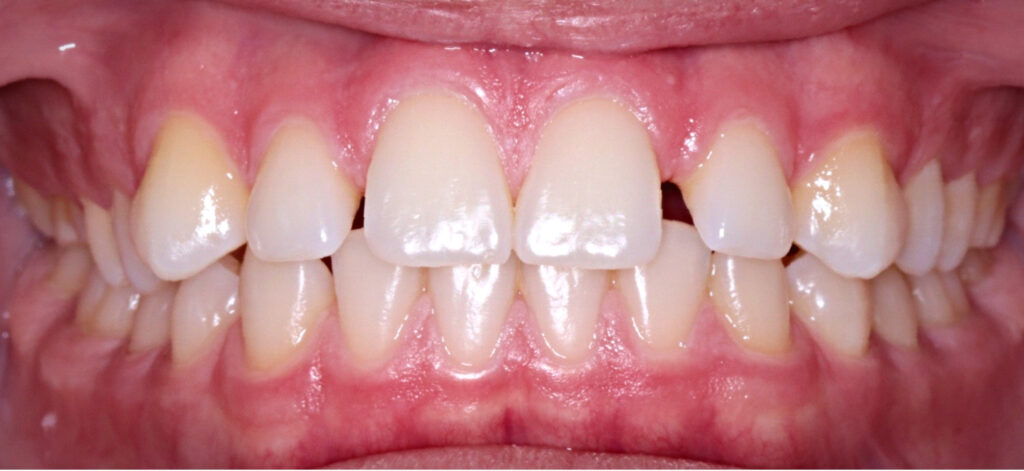 Case 10 before orthodontic treatment