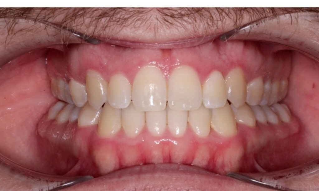 Case 11 after orthodontic treatment