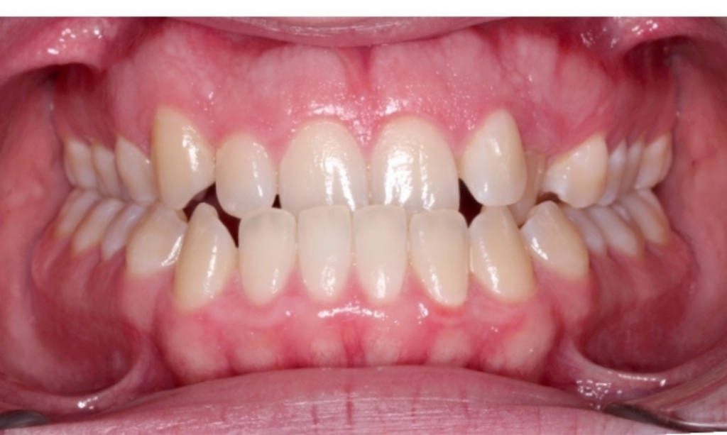 Case 11 before orthodontic treatment