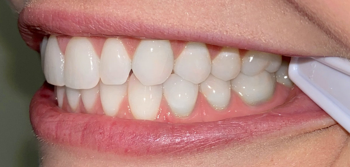 Example photo: teeth together, front view