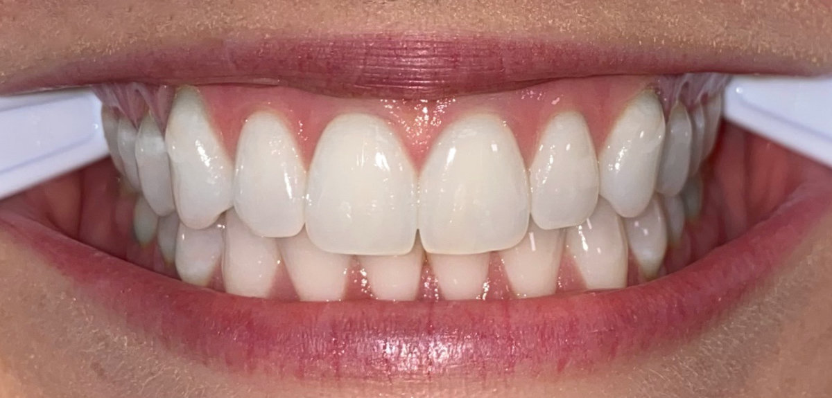 Example photo: teeth together, left side