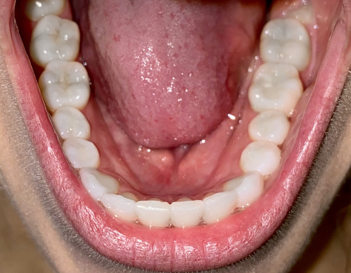 Example photo: lower teeth from above
