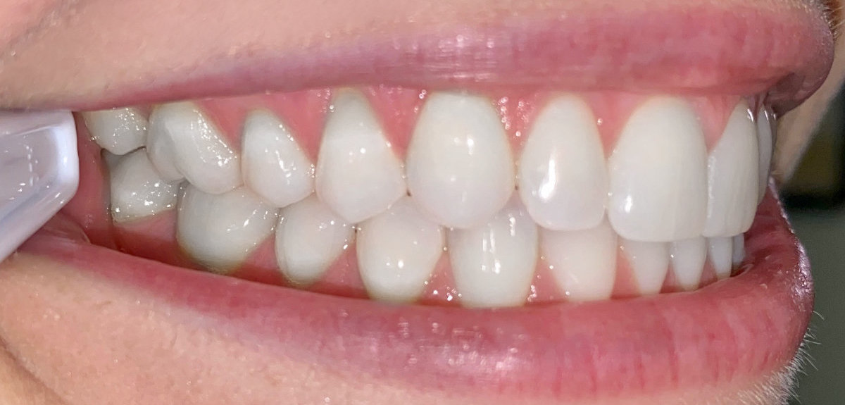 Example photo: teeth together, right side