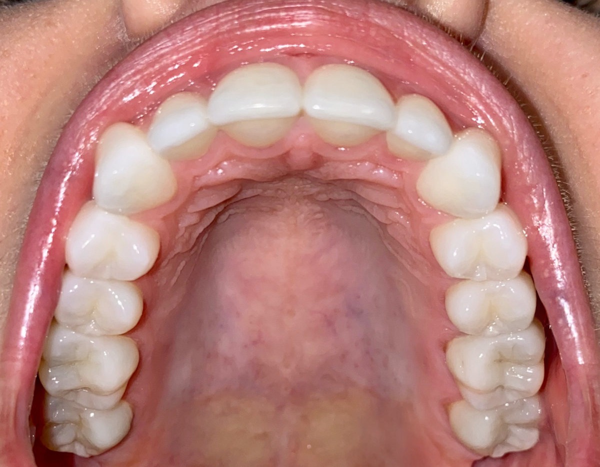 Example photo: upper teeth from below